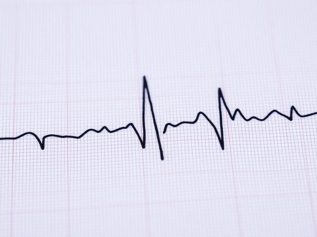 Trazo de electrocardiograma sobre papel cuadriculado